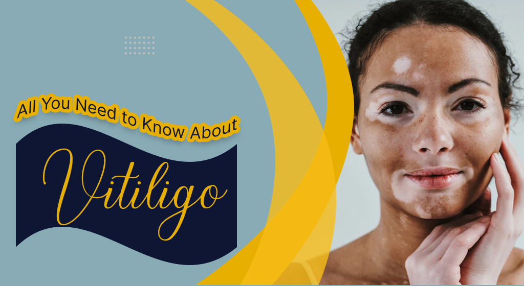 AllYouNeedtoKnowAboutVitiligo.jpg